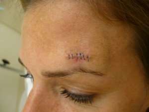 reconstructive-surgery-after-skin-cancer reconstructive-surgery-after-skin-cancer