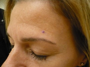 Pictures of Skin Cancer : Before & After Mohs Surgery