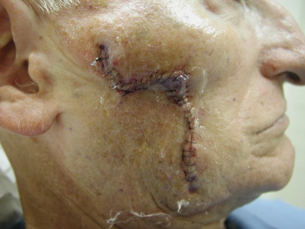 skin-cancer-pictures-after-reconstructive-surgery skin-cancer-pictures-after-reconstructive-surgery