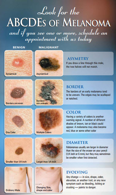 ABCDE's of Melanoma - Jupiter Dermatology & Hair Restoration