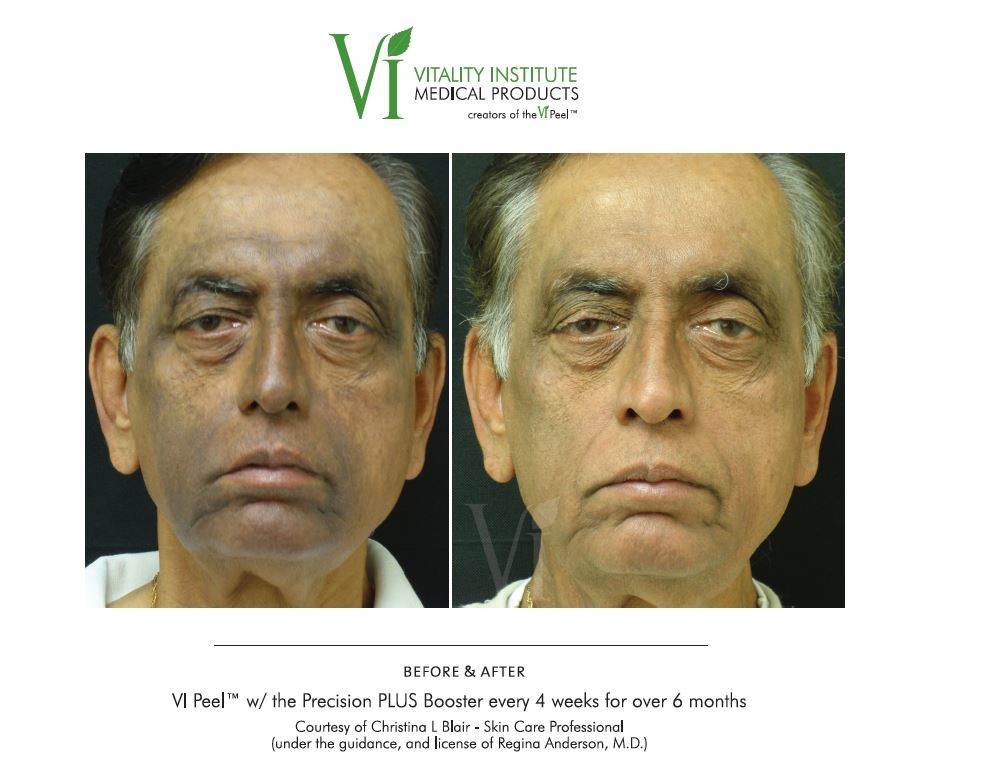 vi-peel-for-men