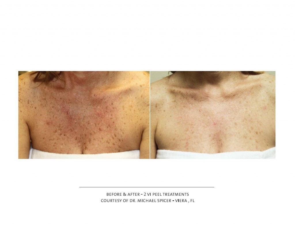 Vi Peel Special Event jupiter