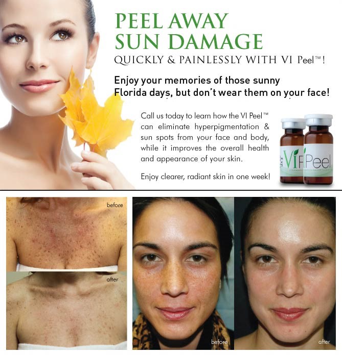 vi-peel