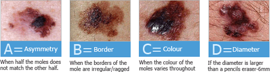 compound nevus mole