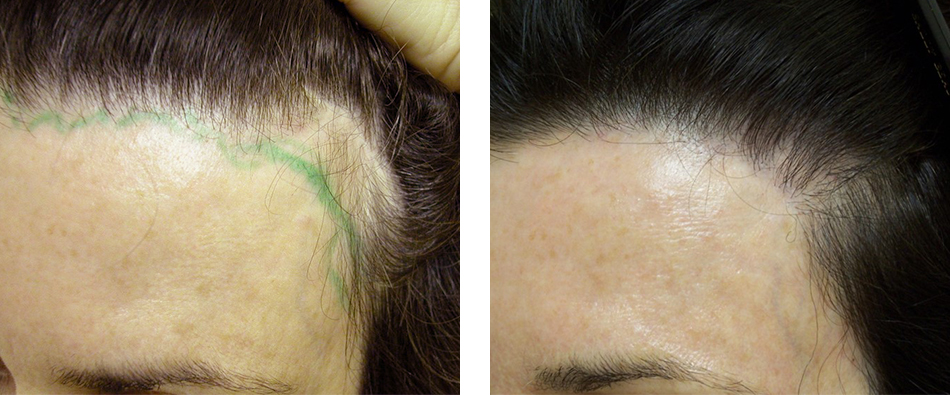Female Hair Restoration Case #1