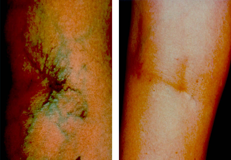 Sclerotherapy Case #2