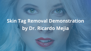 Skin Tag Removal Demonstration by Dr. Ricardo Mejia