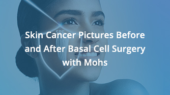 Skin Cancer Pictures Before And After Basal Cell Surgery with Mohs