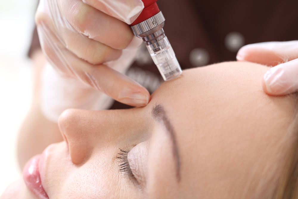 microneedling jupiter fl