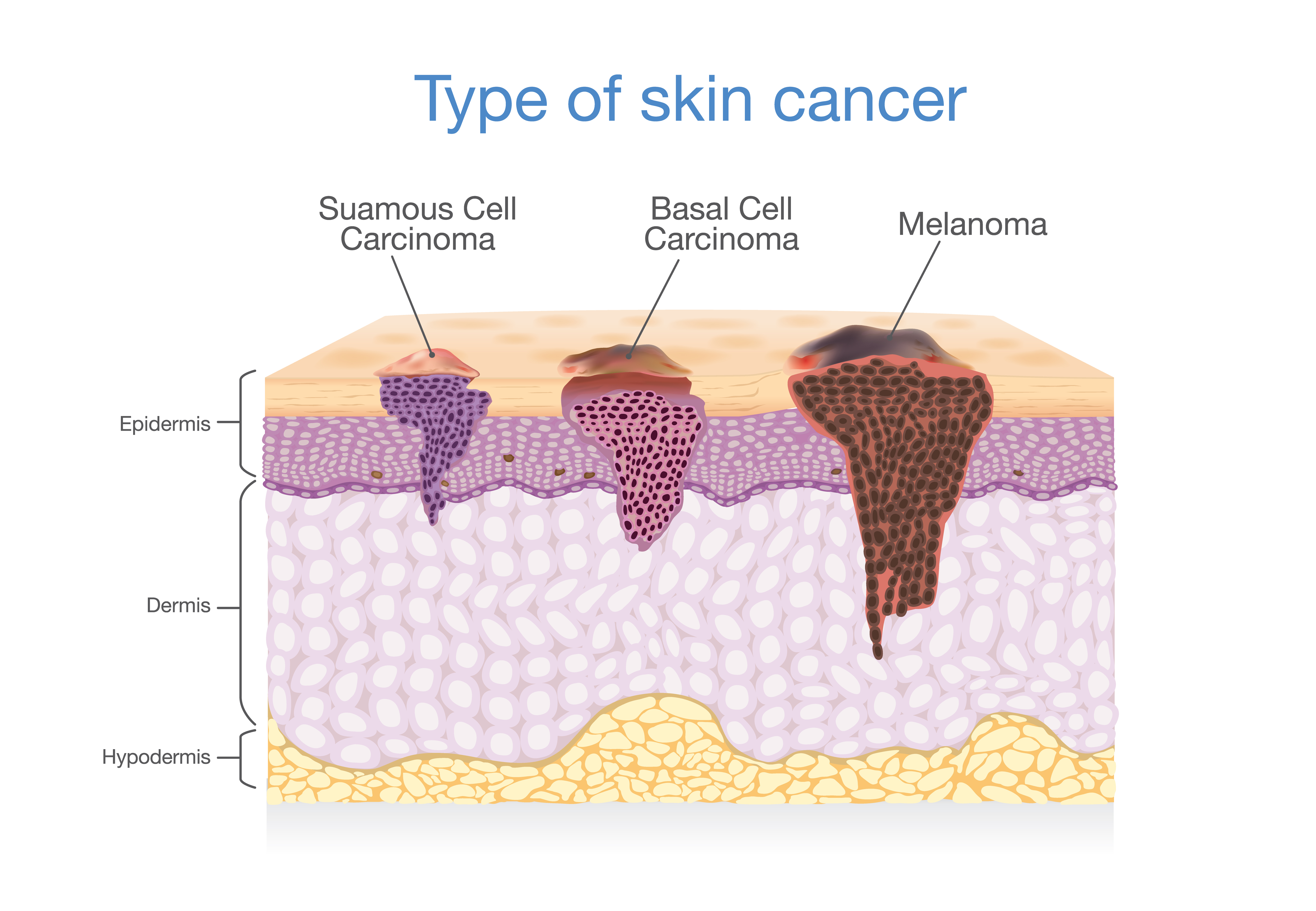 skin cancer jupiter fl