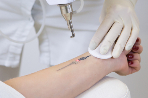 tattoo removal jupiter fl