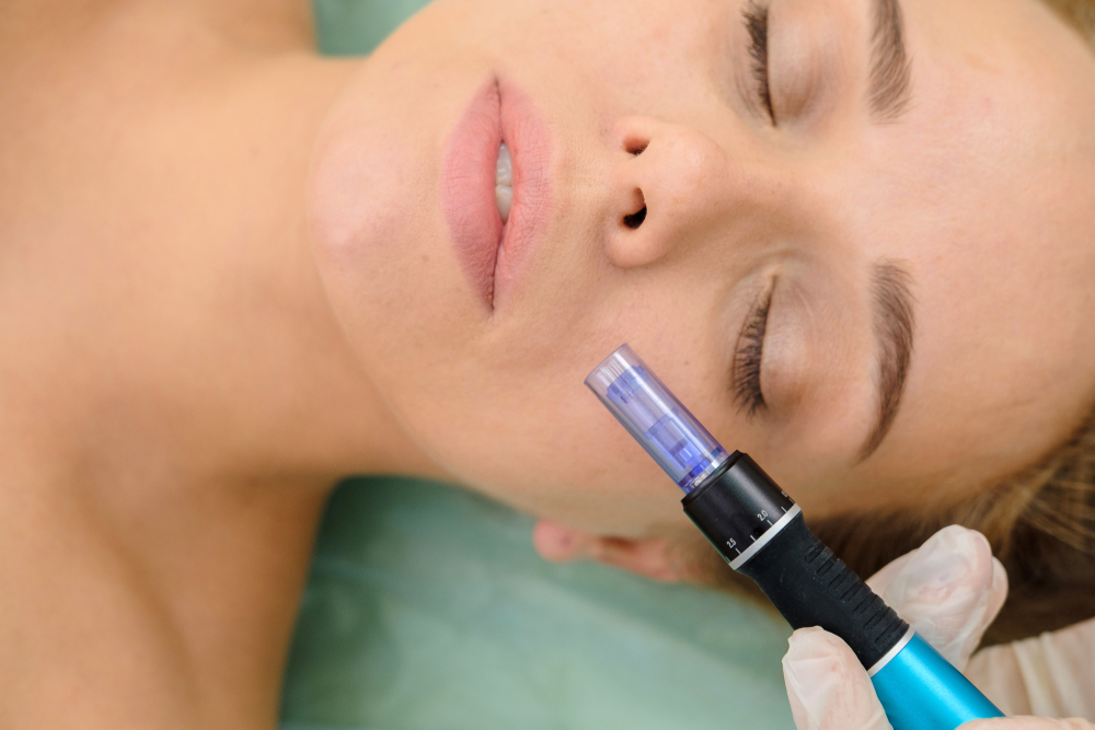 microneedling jupiter fl