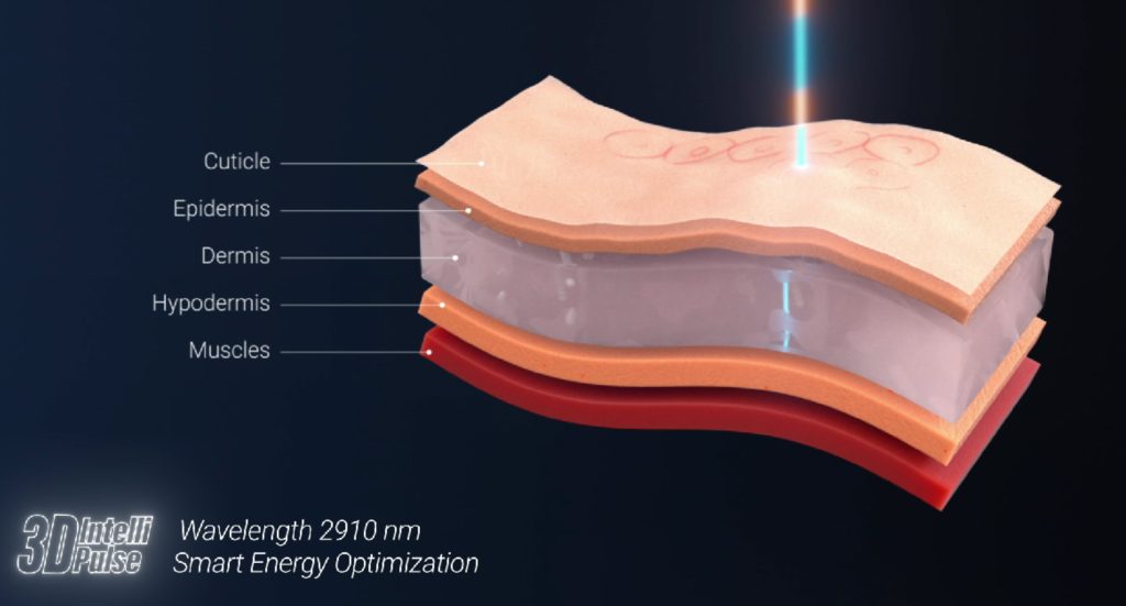 Ultra Clear Laser Treatment Jupiter Dermatology Hair Restoration