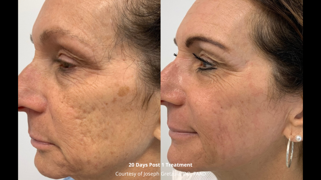 ultra clear before after acne scars