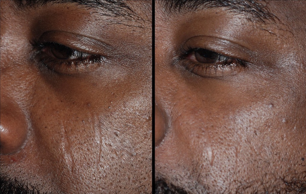 ultra clear skin scars